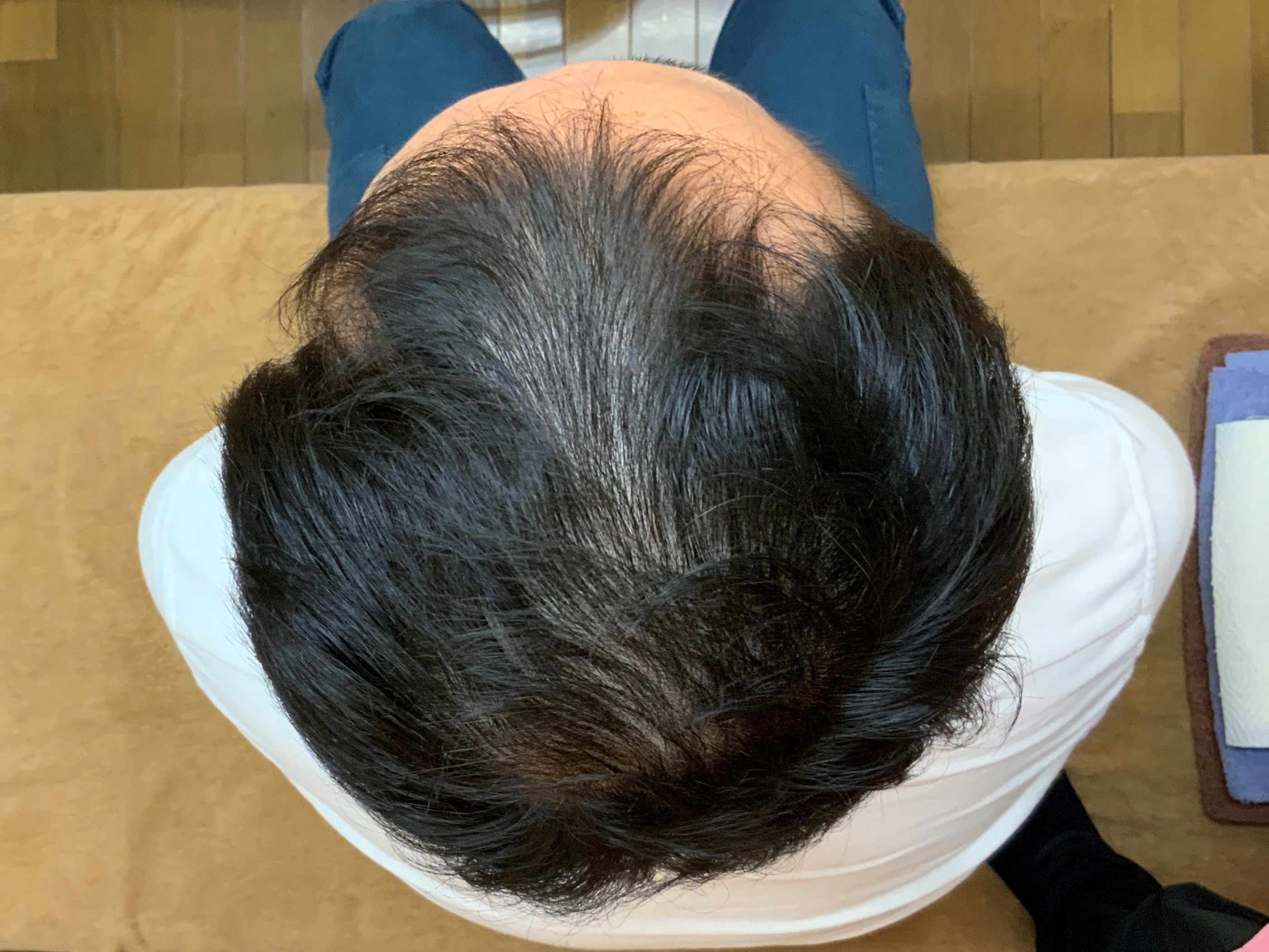 AGA・薄毛治療ビフォーアフター