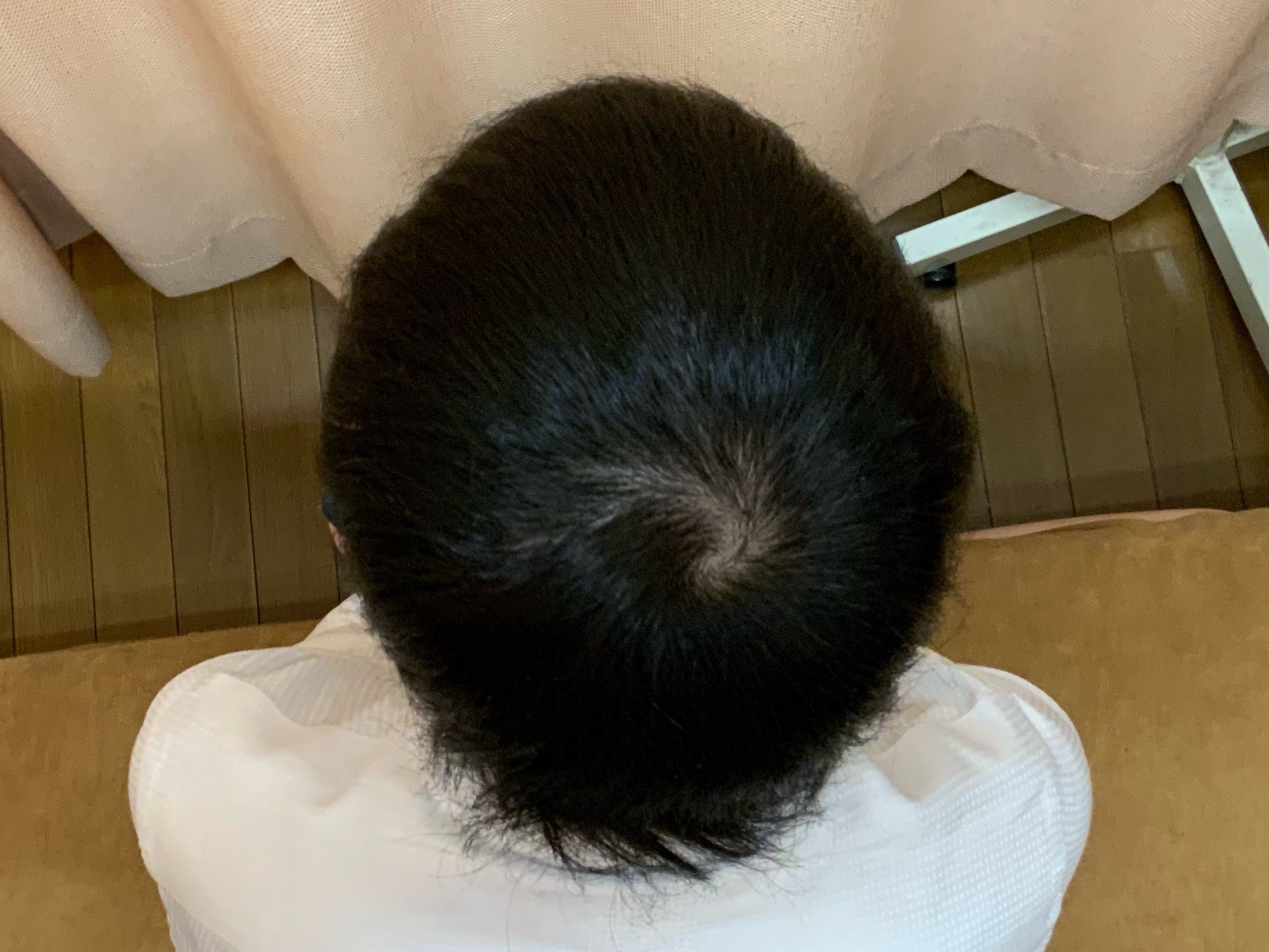 AGA・薄毛治療ビフォーアフター