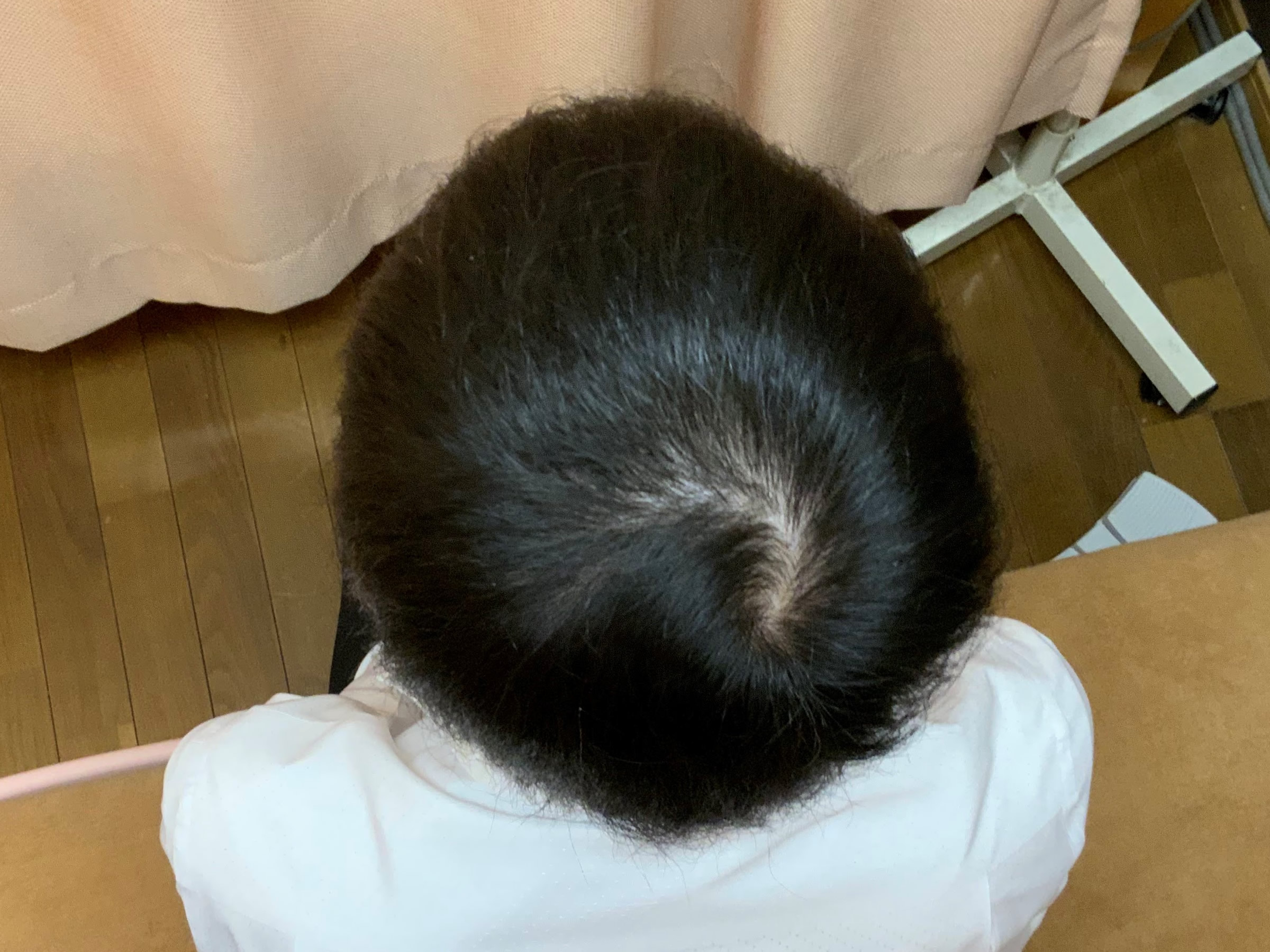 AGA・薄毛治療ビフォーアフター