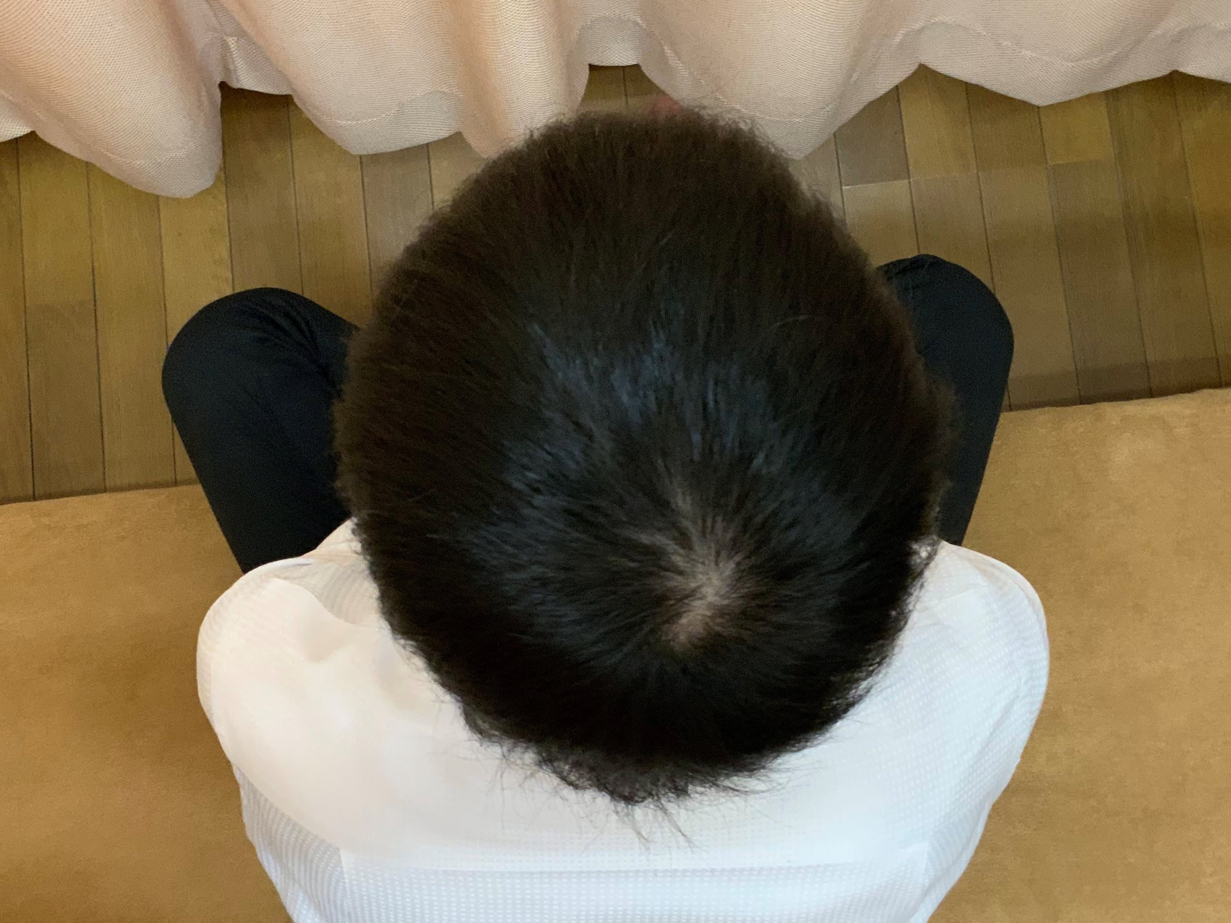 AGA・薄毛治療ビフォーアフター